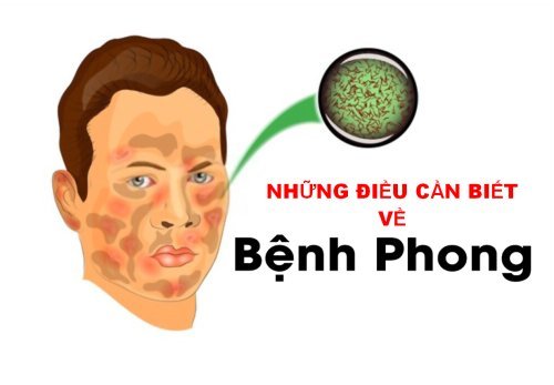 bệnh phong 1.jpg